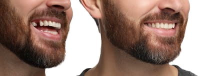 Fixing Cracked Teeth with Durable Dental Crowns in Arlington