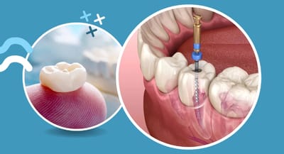 How Dental Crowns in Arlington Improve Both Function and Aesthetics