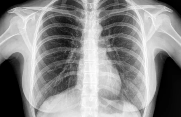 Chest x-ray