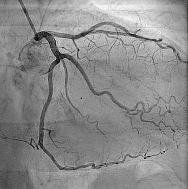 Angiography