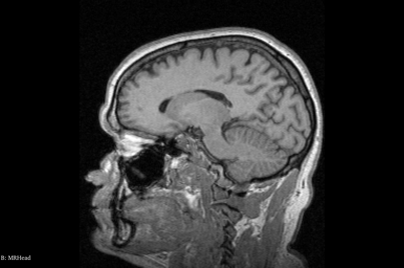 Brain MRI