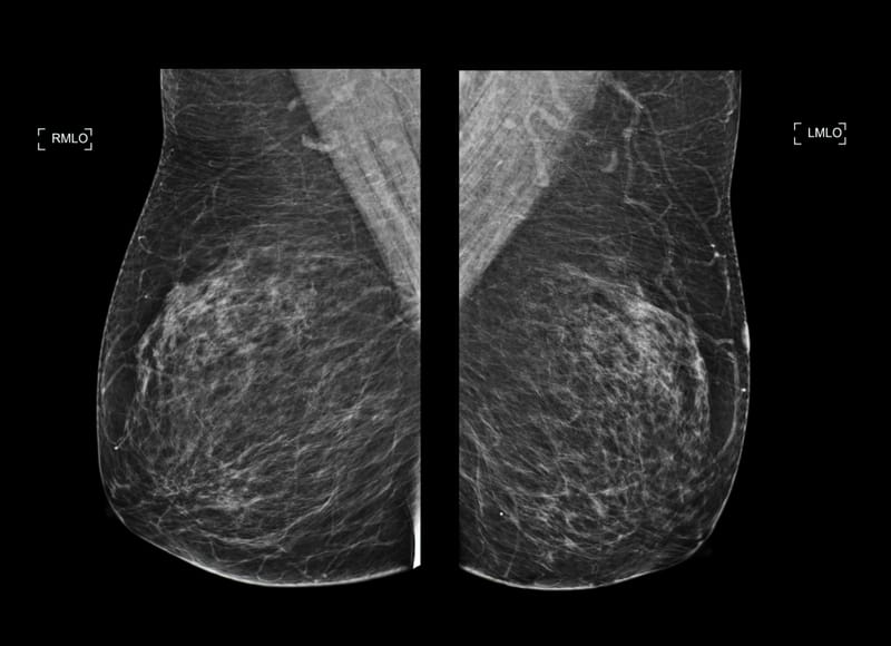 Mammography