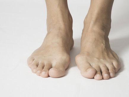 מאמר: בוהן קלובה (Hallux Valgus) - תסמינים, גורמים ודרכי טיפול