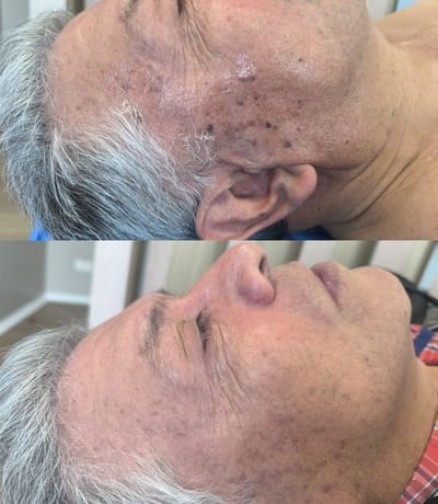 Eliminación de verrugas y queratosis seborreica con láser: un procedimiento seguro y eficaz