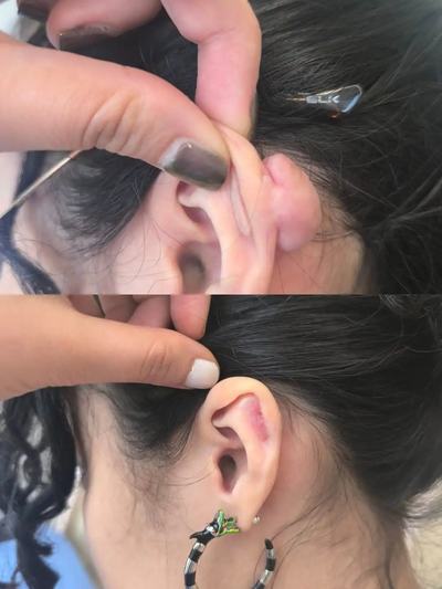 ¿Tienes un queloide en la oreja? Descubre cómo eliminarlo con tratamiento dermatológico