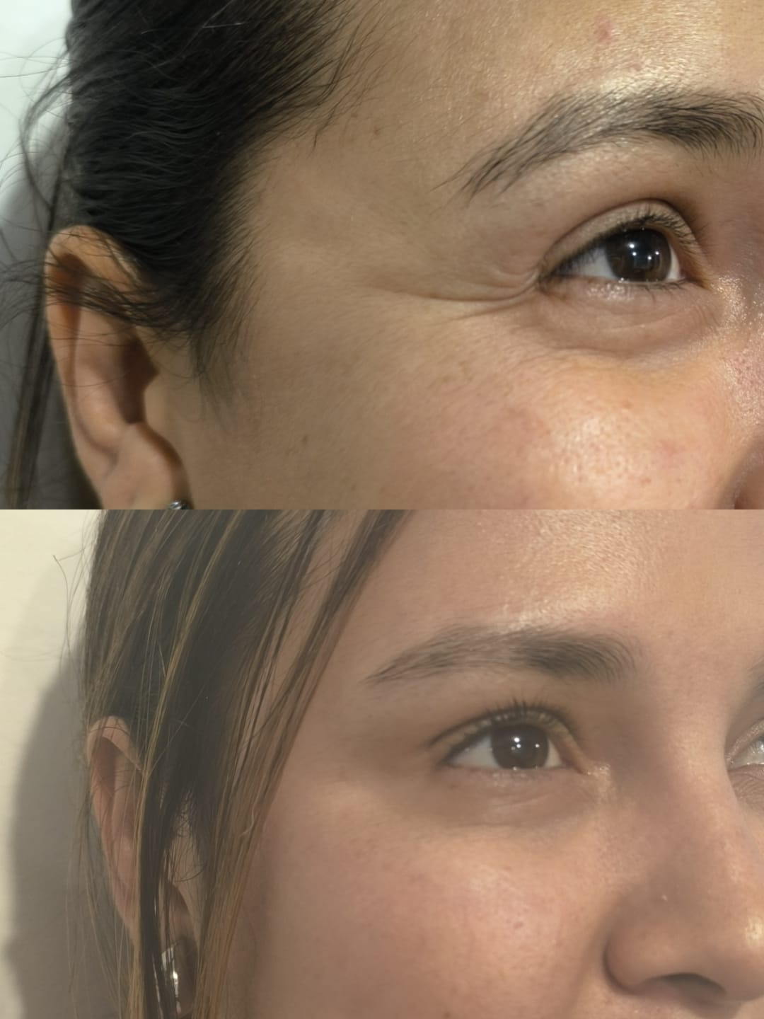 Antes y después del tratamiento con toxina botulínica en patas de gallina.