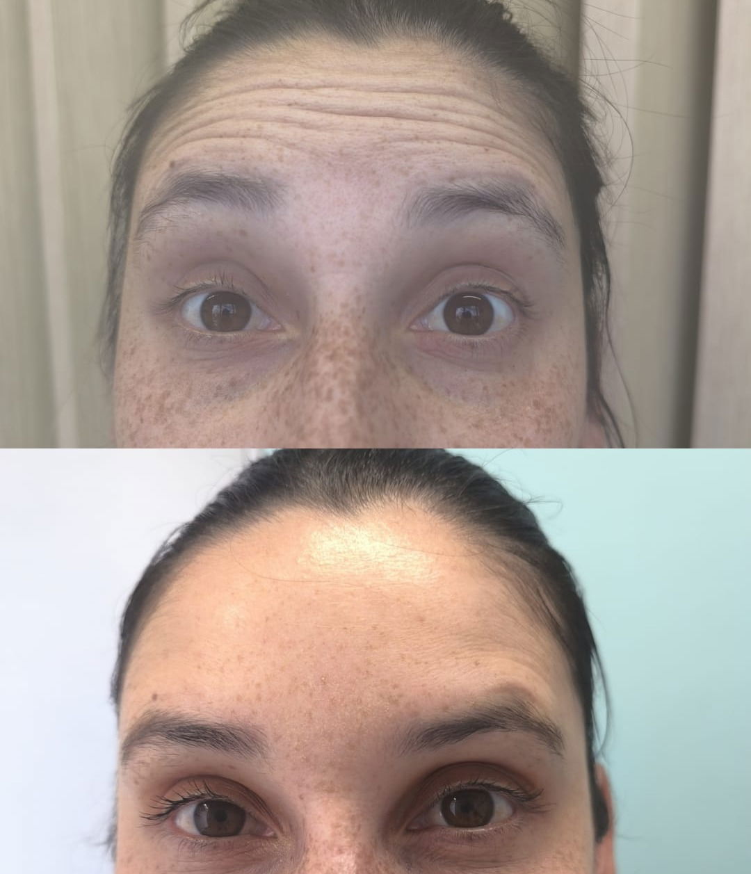 Antes y después del tratamiento con toxina botulínica para líneas de expresión frente