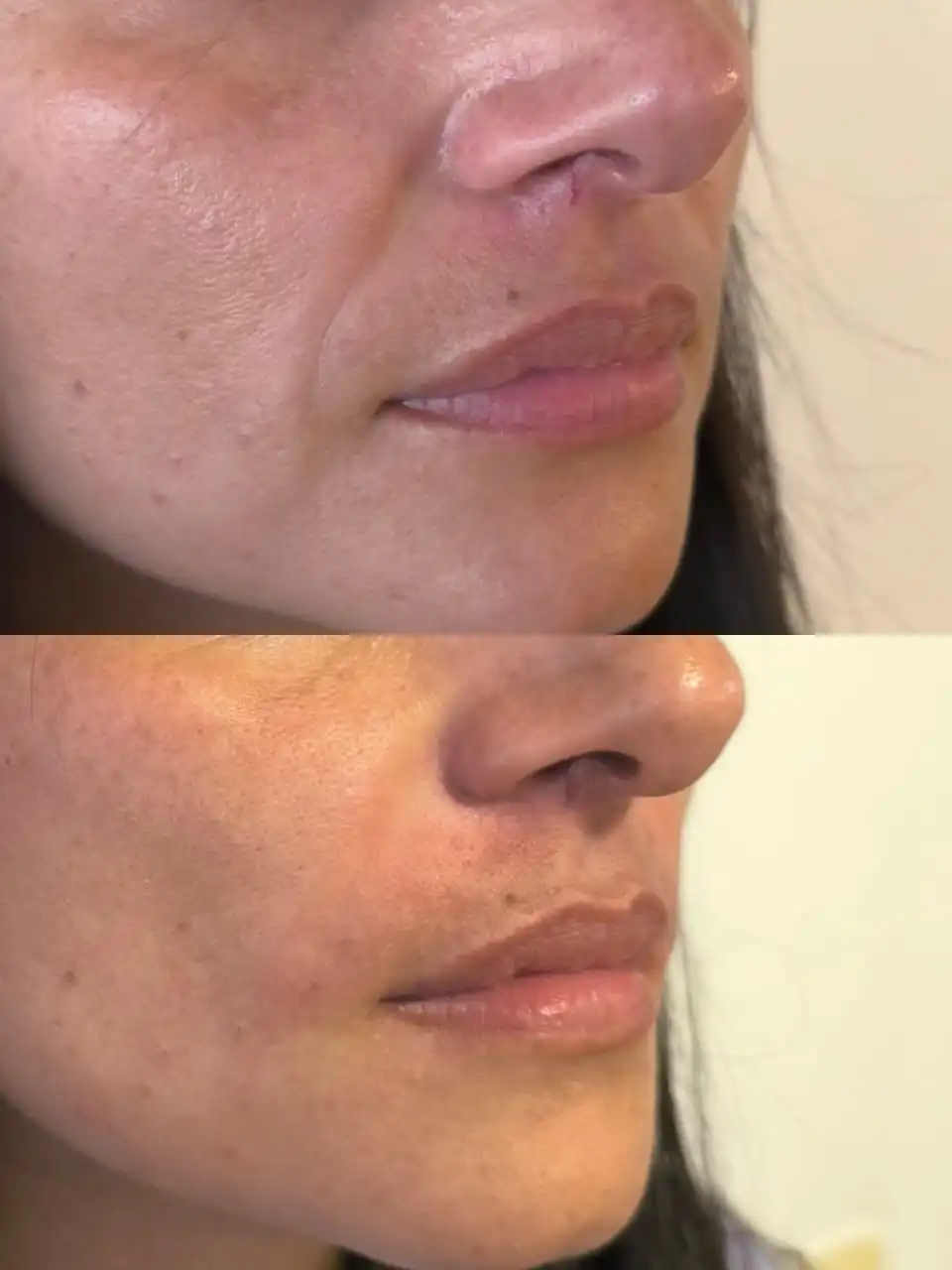 antes-despues-surcos-acido-hialuronico-bogota