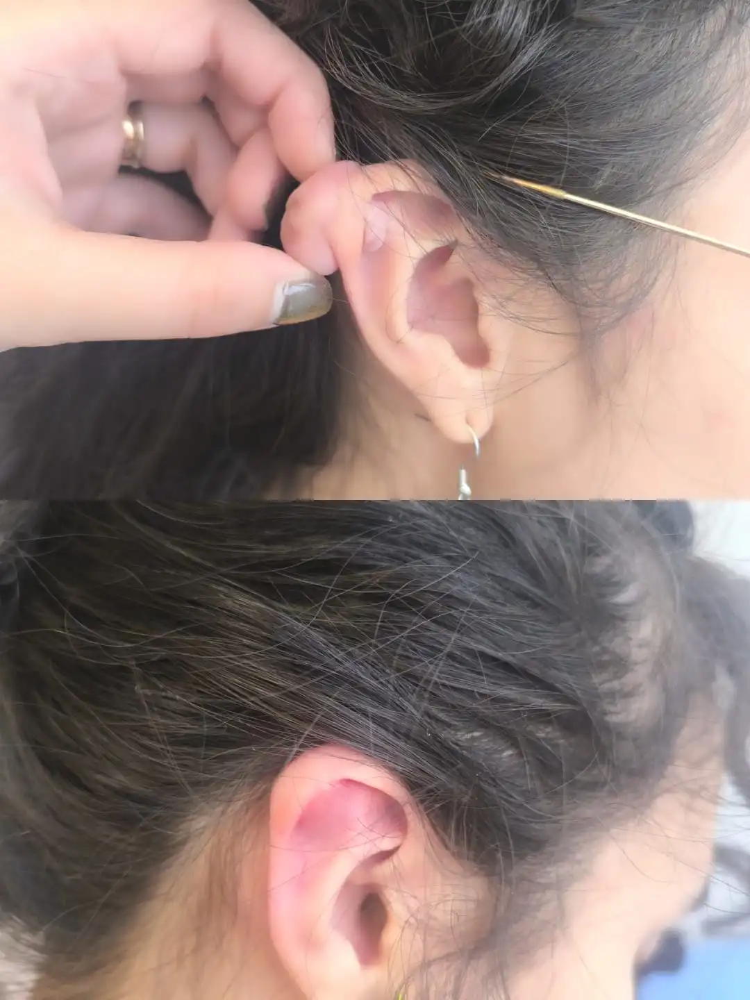 Comparación del antes y después del tratamiento de queloide en la oreja. Caso 1 tratado por la Dra. Susana Pérez con reducción visible del volumen.