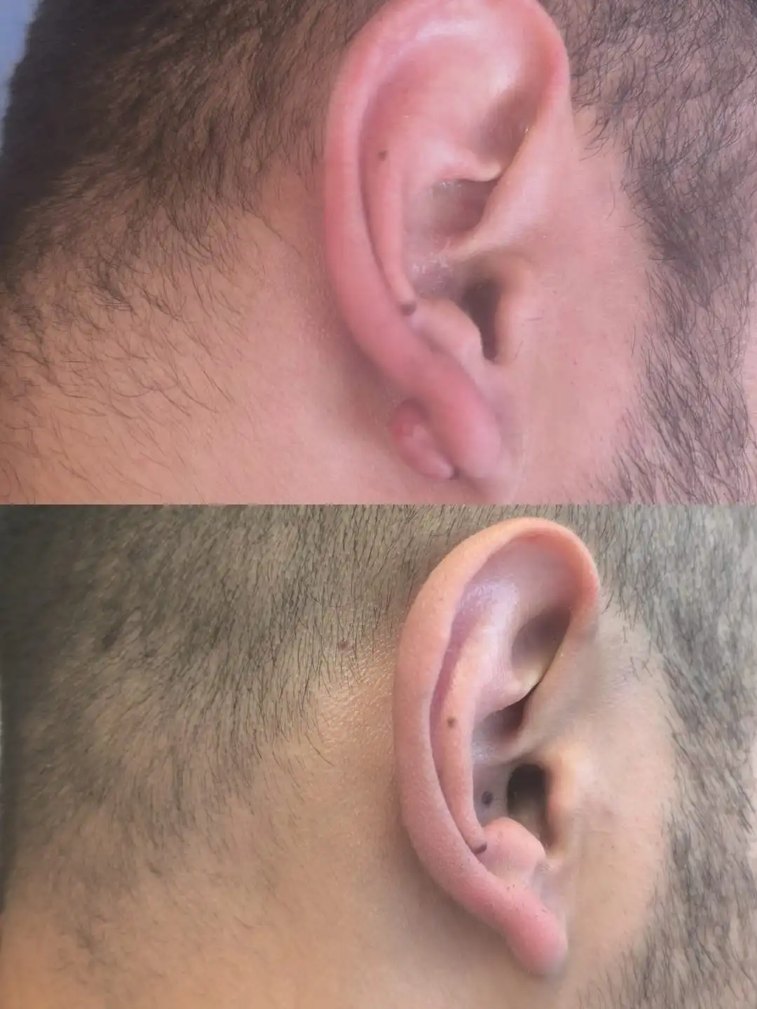 Comparación del antes y después del tratamiento de queloide en la oreja. Caso 2 tratado por la Dra. Susana Pérez con reducción visible del volumen.