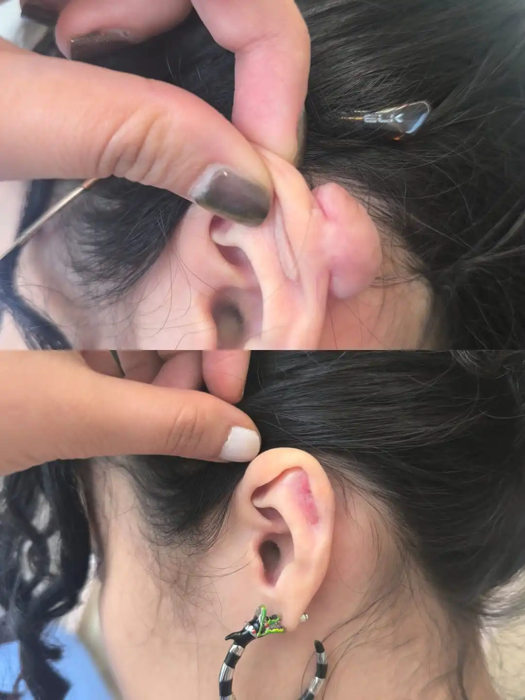 Tratamiento exitoso de queloide en oreja. Foto muestra comparación antes y después con resultado estético natural y cicatrización controlada.