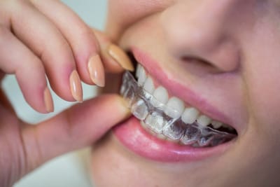 Clear Aligners Dubai: A Modern Solution for a Perfect Smile – Loldent Dental Clinic