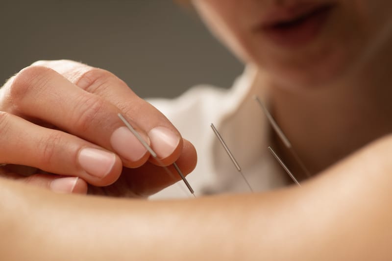 Acupuncture