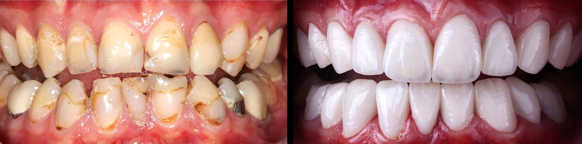 Ceramic Dental Veneers at Versailles Dental Clinic