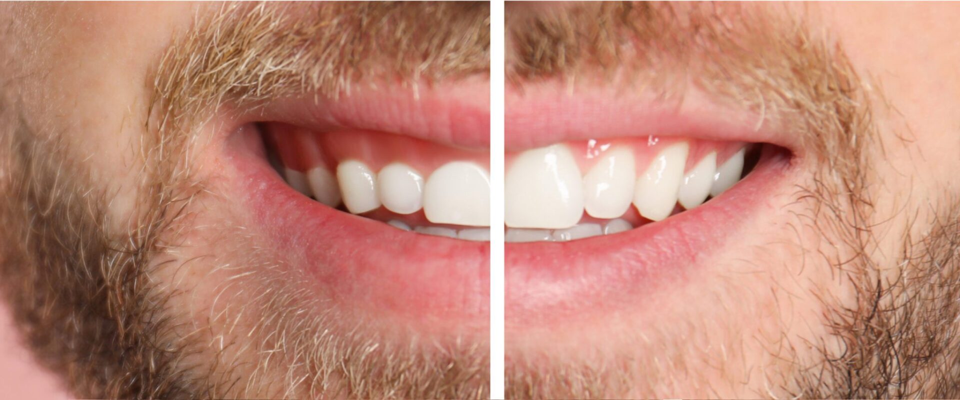 Gum Contouring at Versailles Dental Clinic