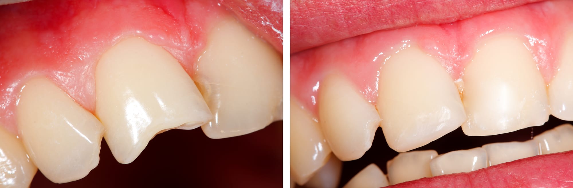 Swift Solutions for Broken or Chipped Teeth