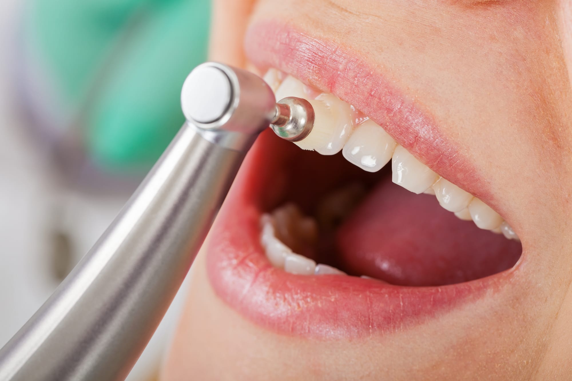 Discover the Benefits of Teeth Scaling and Polishing