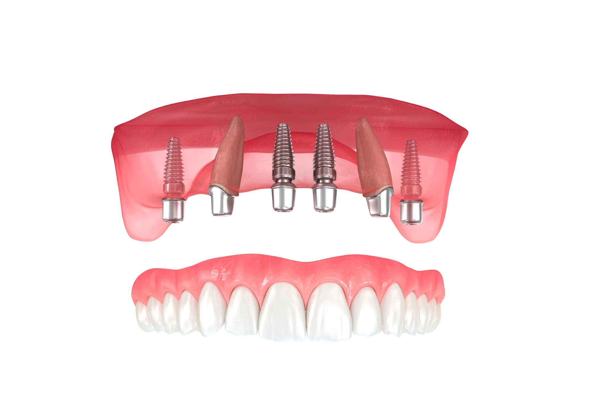 All-on-4 Dental Implants: A Revolutionary Full-Arch Solution