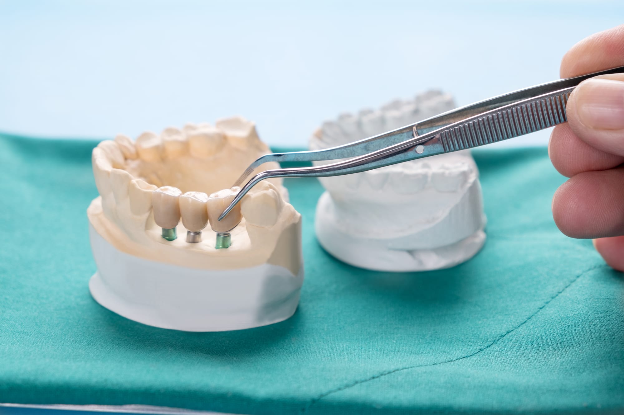 How to Choose the Right Ceramic & Zirconia Dental Crowns in Dubai for Your Smile