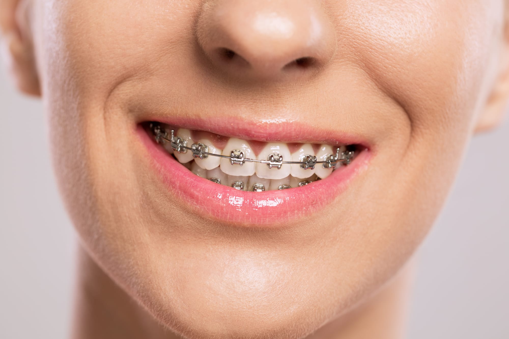 How to Care for Your Teeth While Wearing Braces: Tips for a Healthy Smile