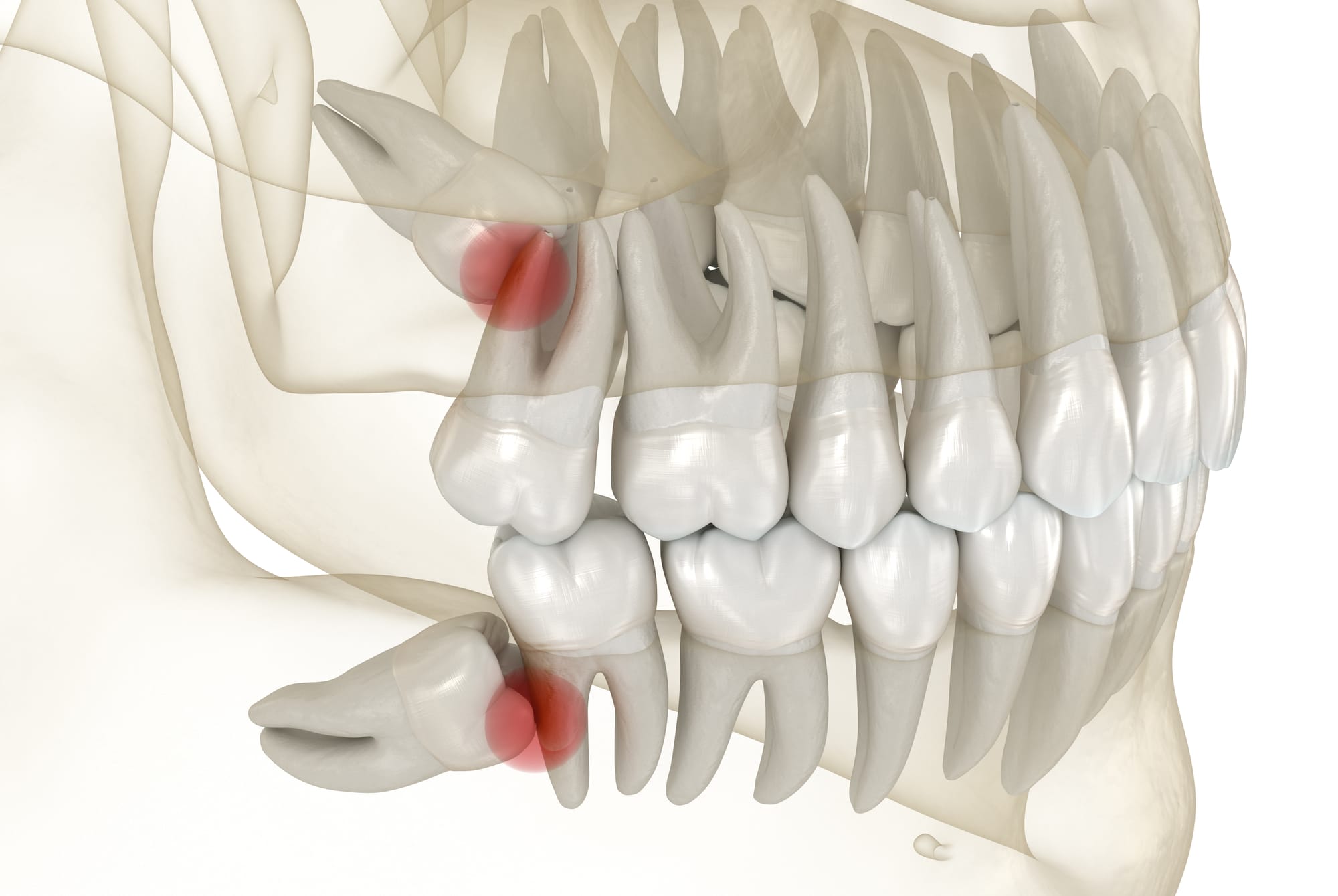 The Complete Guide to Painless Wisdom Teeth Extraction in Dubai