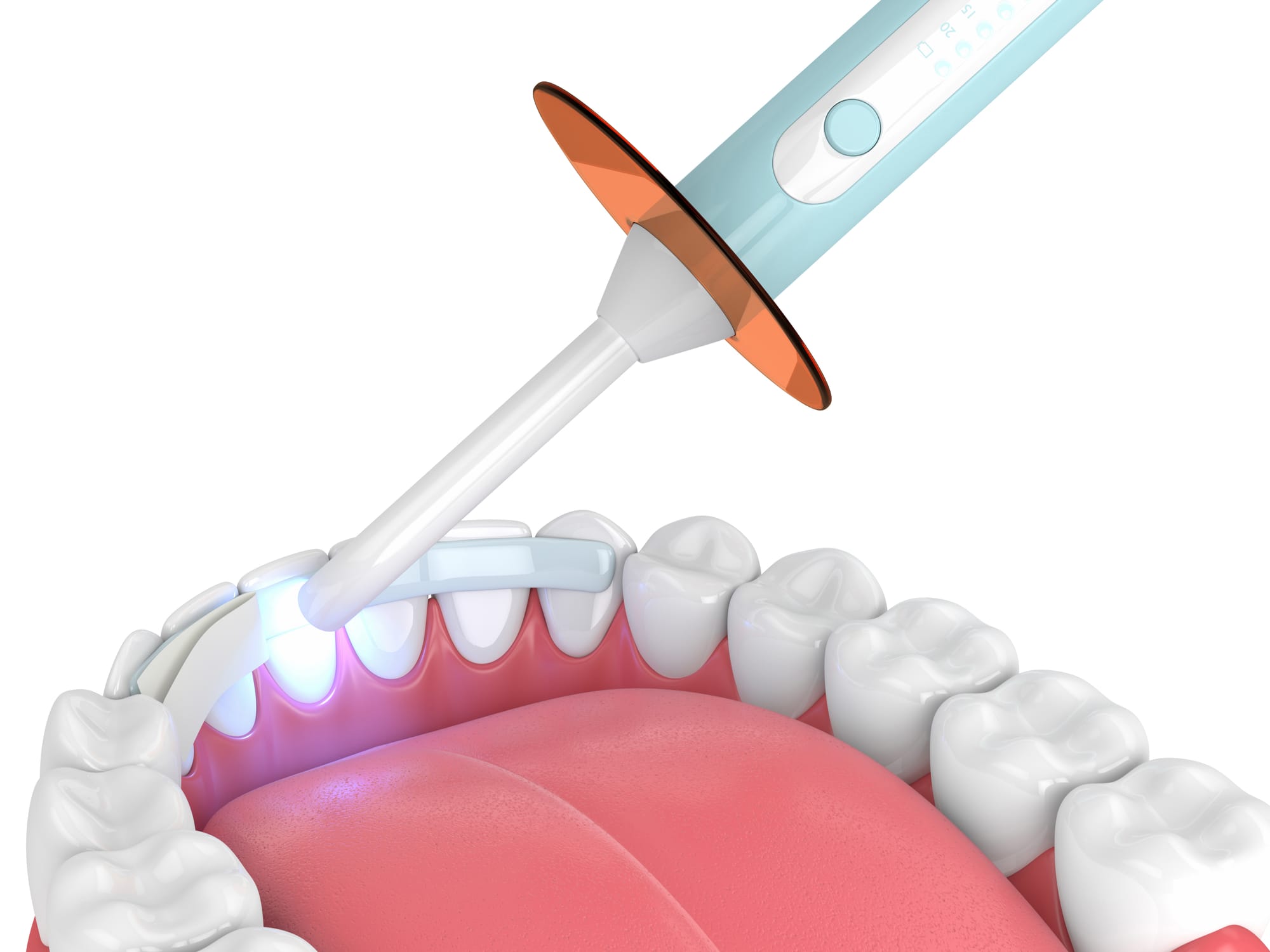 Top Benefits of Choosing Dental Bonding in Dubai for a Perfect Smile