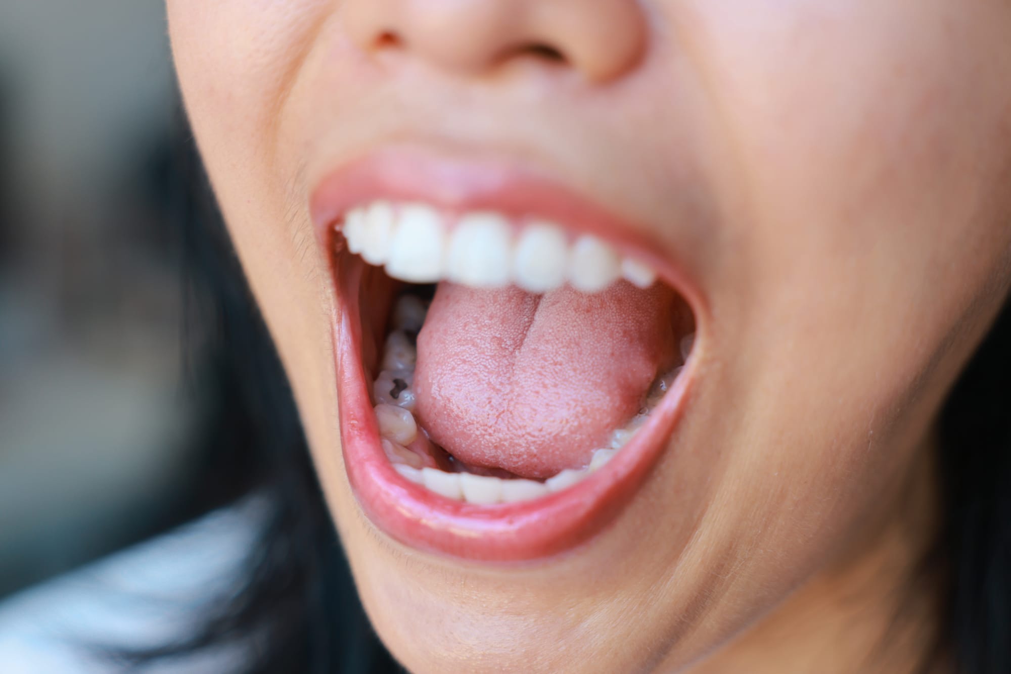 SMART Dental Amalgam Removal: Protecting Your Health and Smile