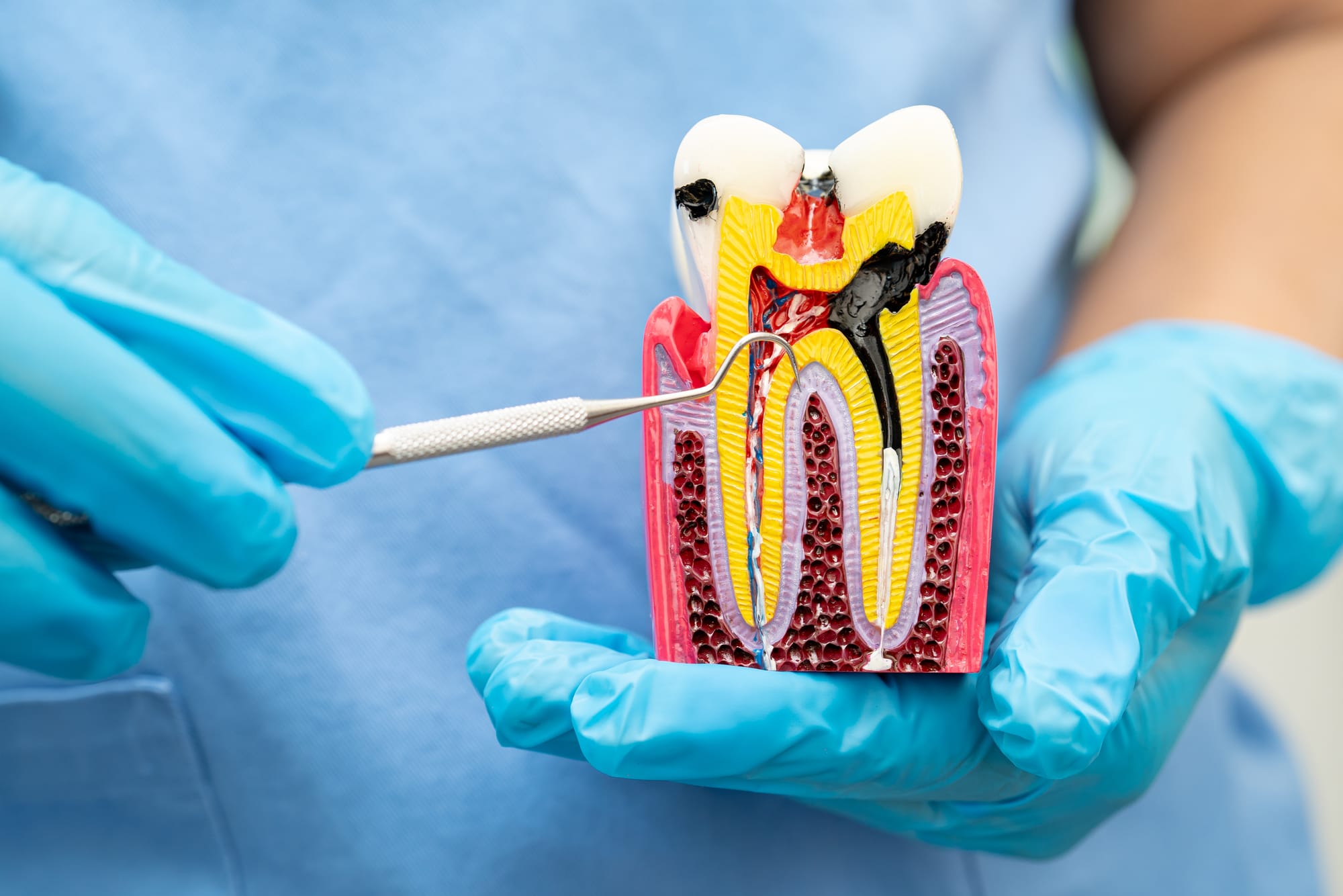 Understanding the Root Canal Process: Step-by-Step Insight for Dubai Patients