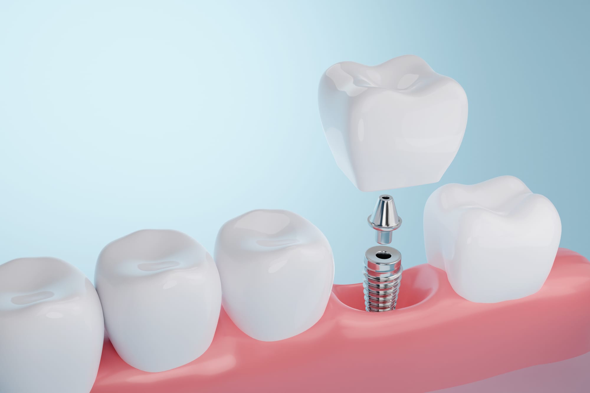 How Long Do Dental Implants Last in Dubai? A Comprehensive Guide