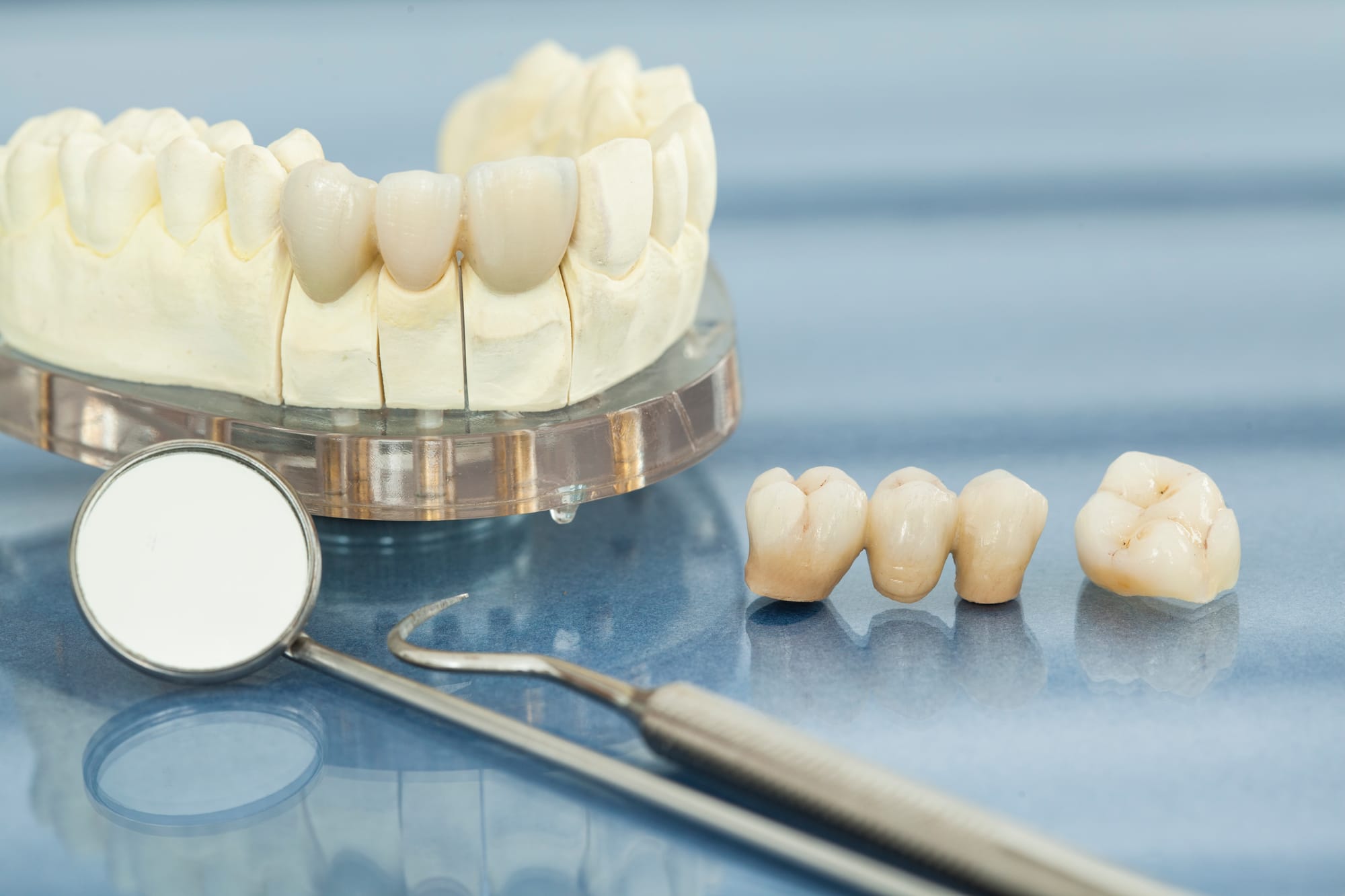 Dental Implants vs. Bridges: Making the Right Choice for Your Smile