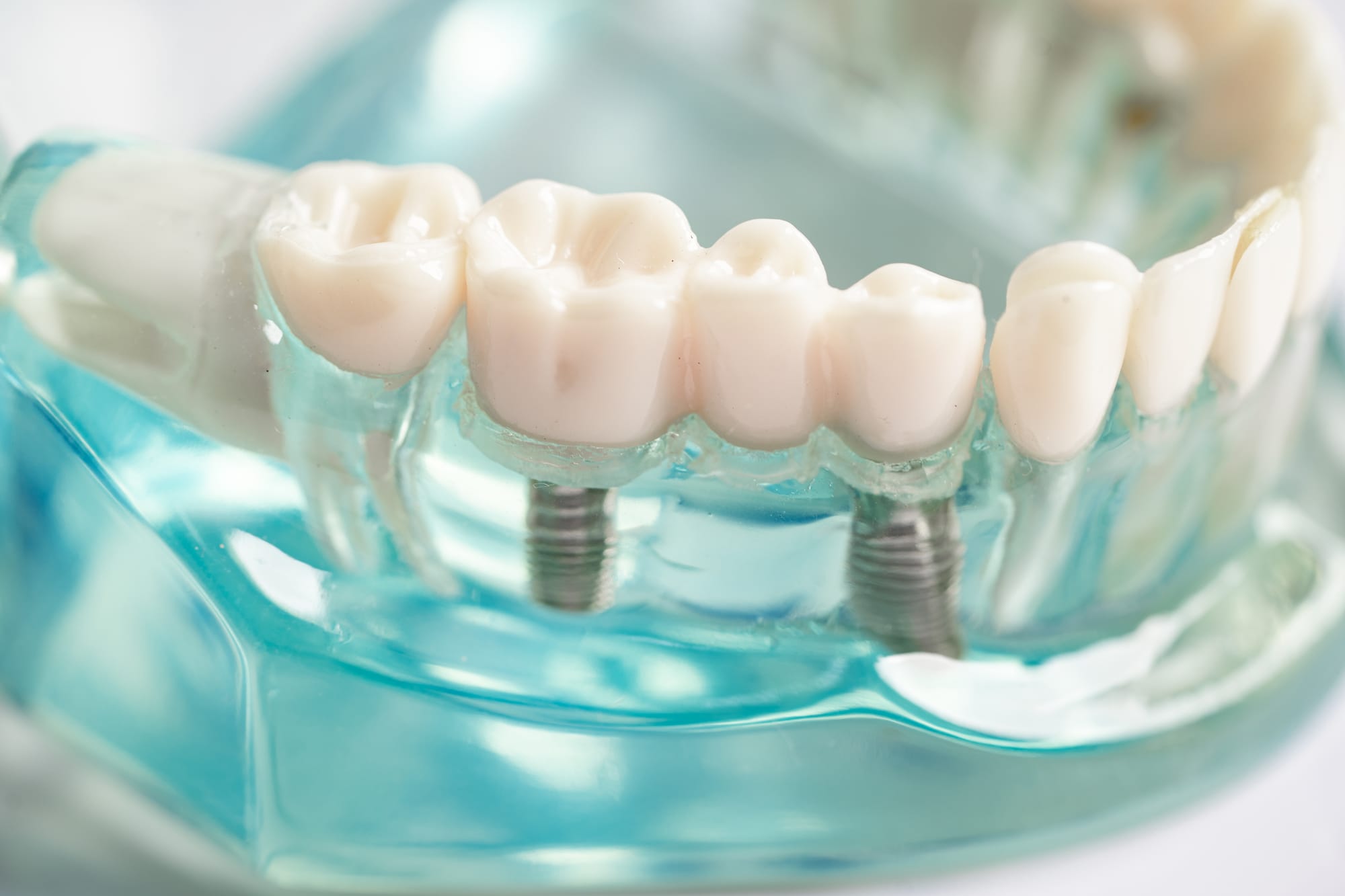 Step-by-Step Process of Getting the Best Dental Implants in Dubai