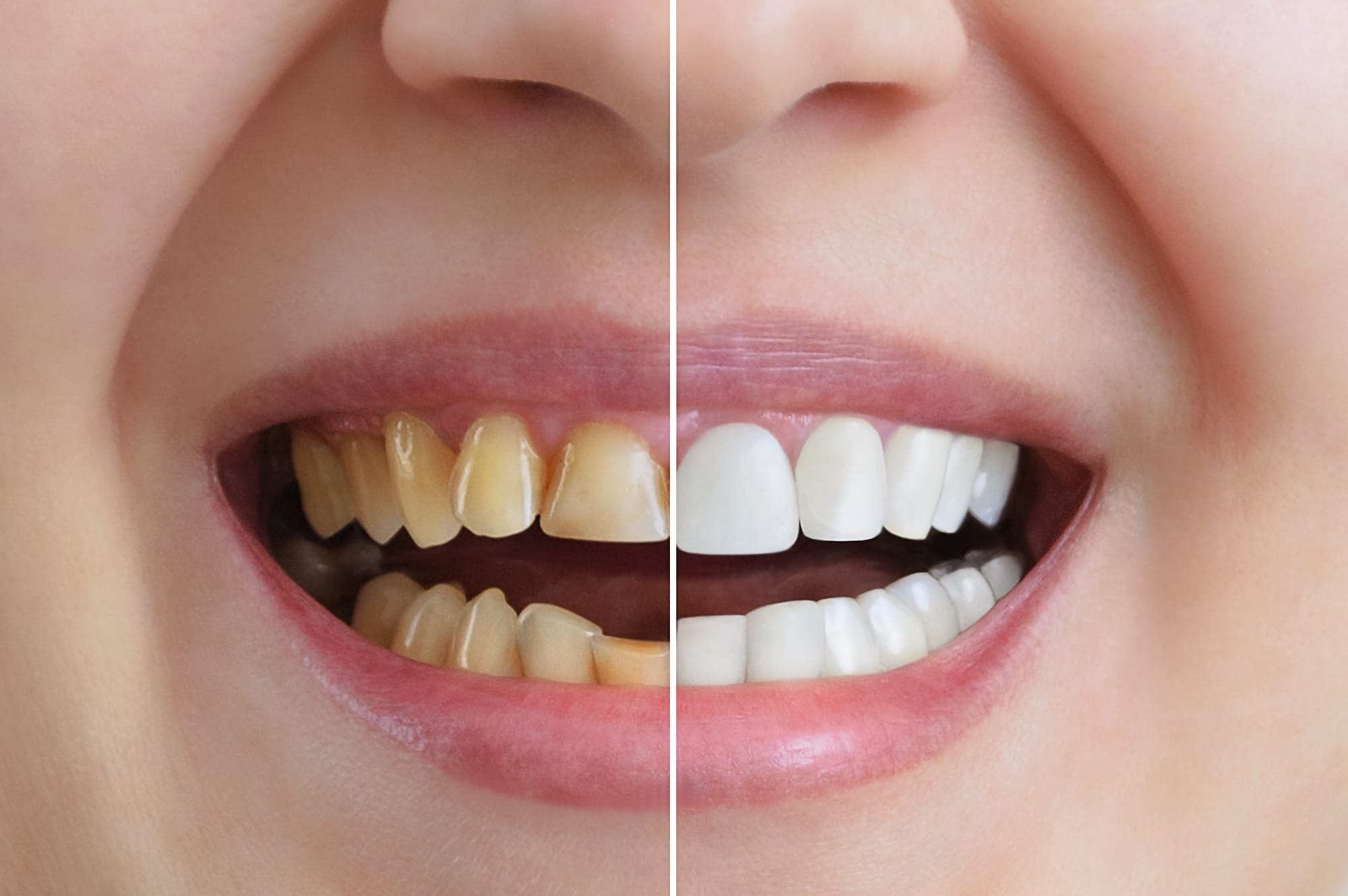 Invisalign and Braces Options from a Cosmetic Dentistry Clinic in Dubai
