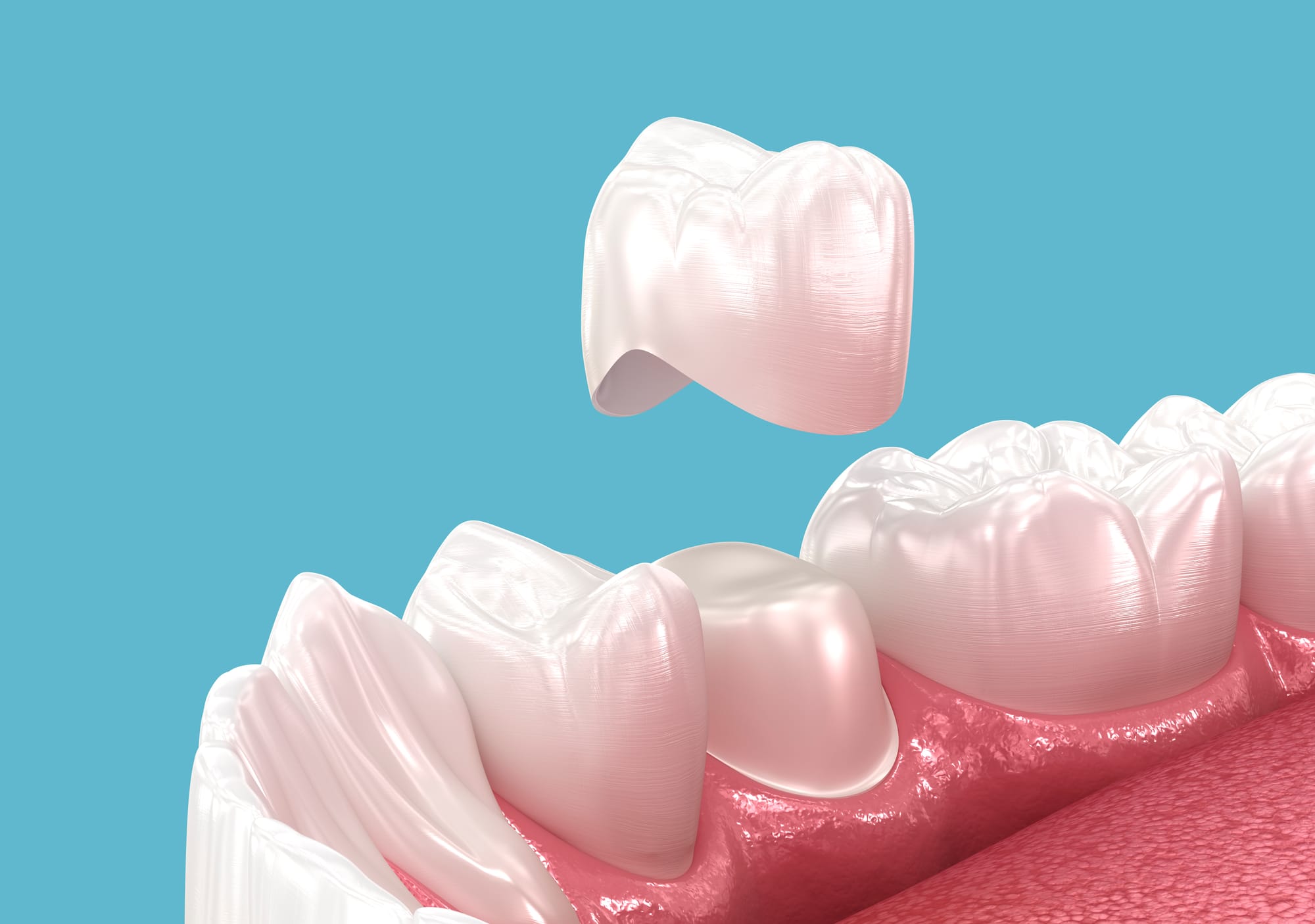 The Step-by-Step Process of Getting Dental Crowns & Bridges in Dubai