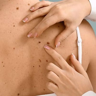 Mole Removal for Melanoma Prevention in Dubai