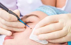 The Positive Impact of Mole Removal on Confidence