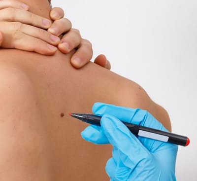 Mole Removal: Reduce Skin Irritation