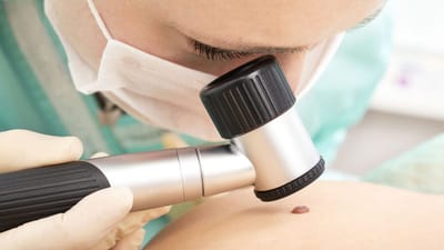 Does Mole Removal Treatment Leave Scars?