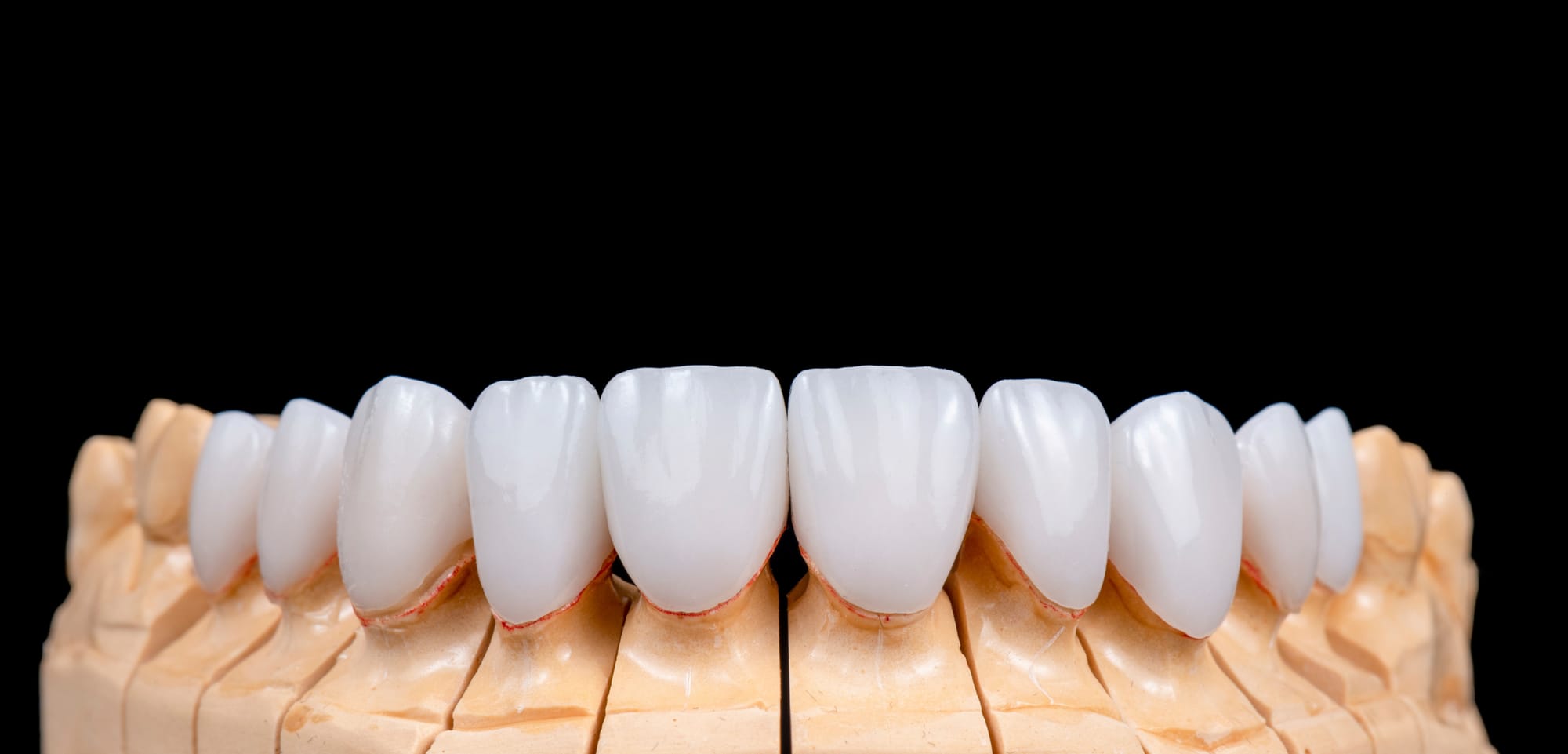 Full Set of Porcelain Veneers – Designed for Symmetry & Perfection