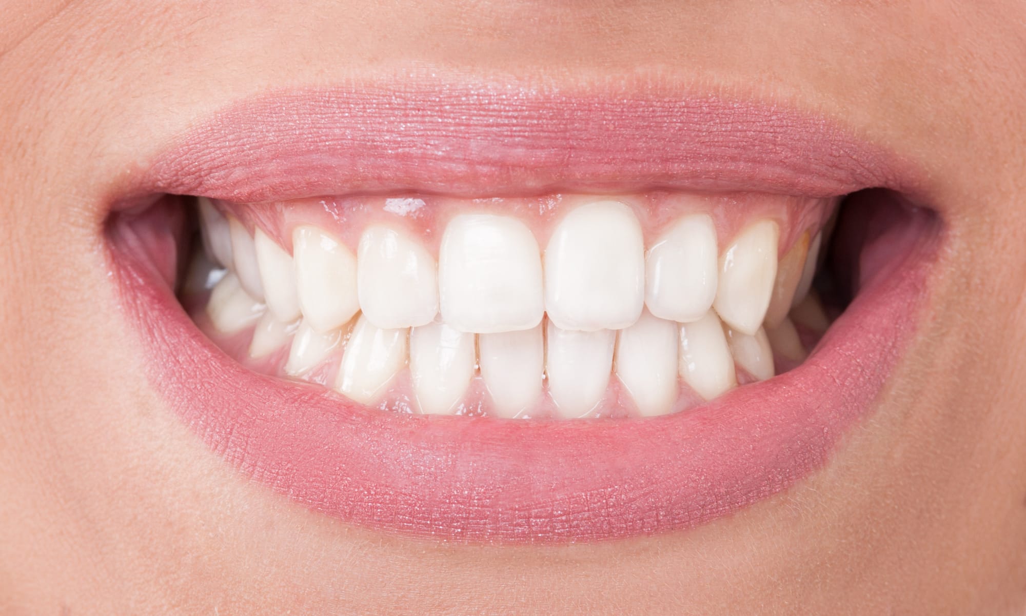 Bright, Symmetrical Smile with Custom Veneers