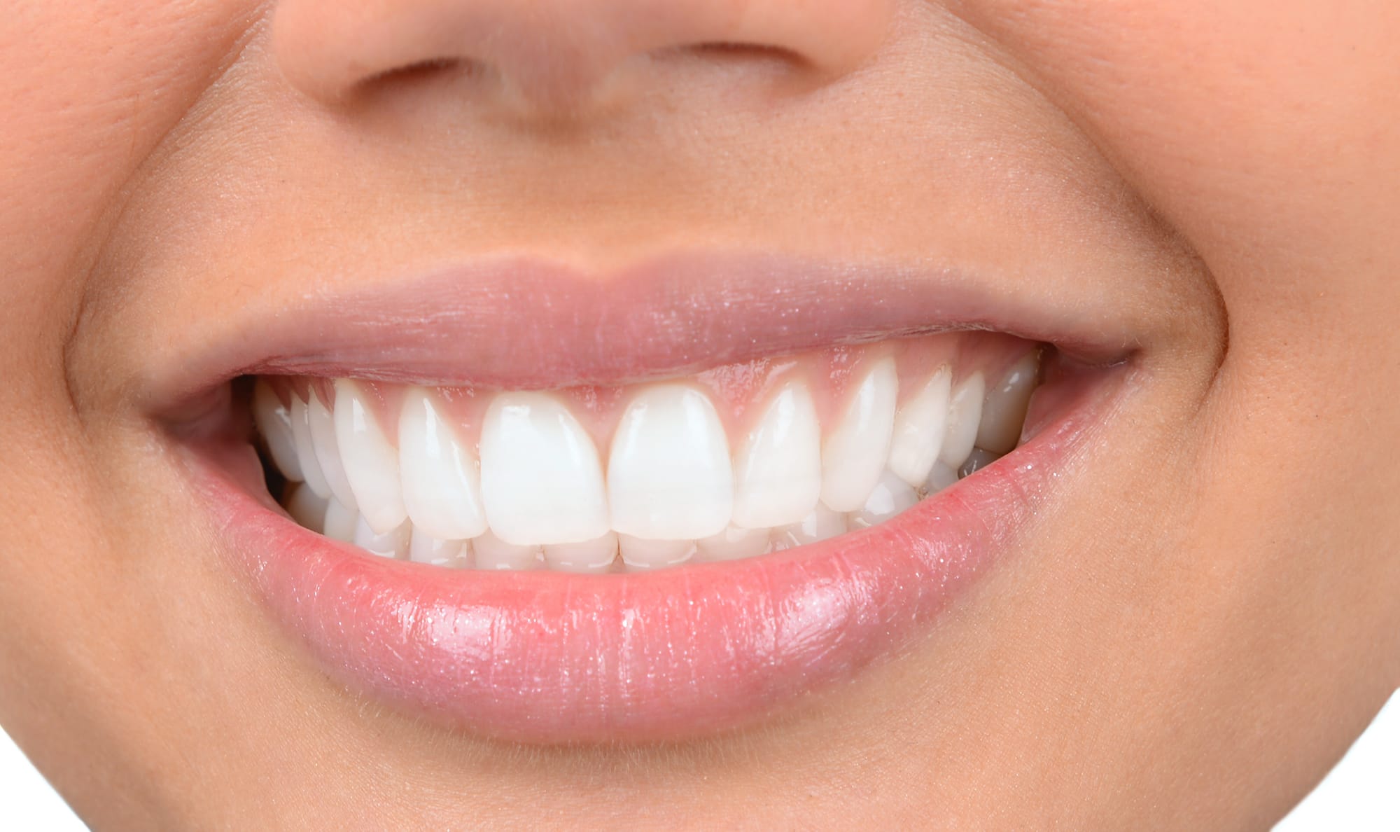 Flawless White Smile with Porcelain Veneers