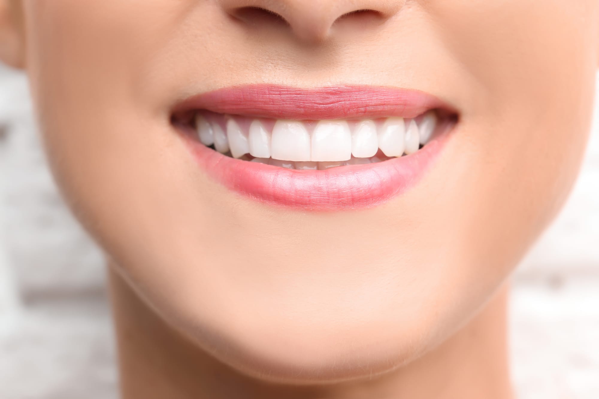 Full Arch Zirconia Bridge – A Complete Smile Transformation