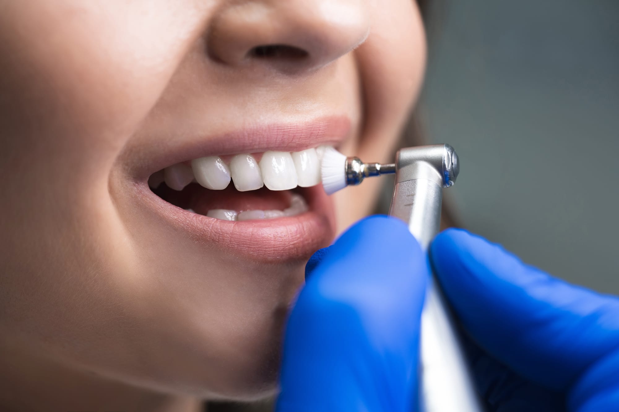 Professional Teeth Cleaning for a Brighter, Healthier Smile