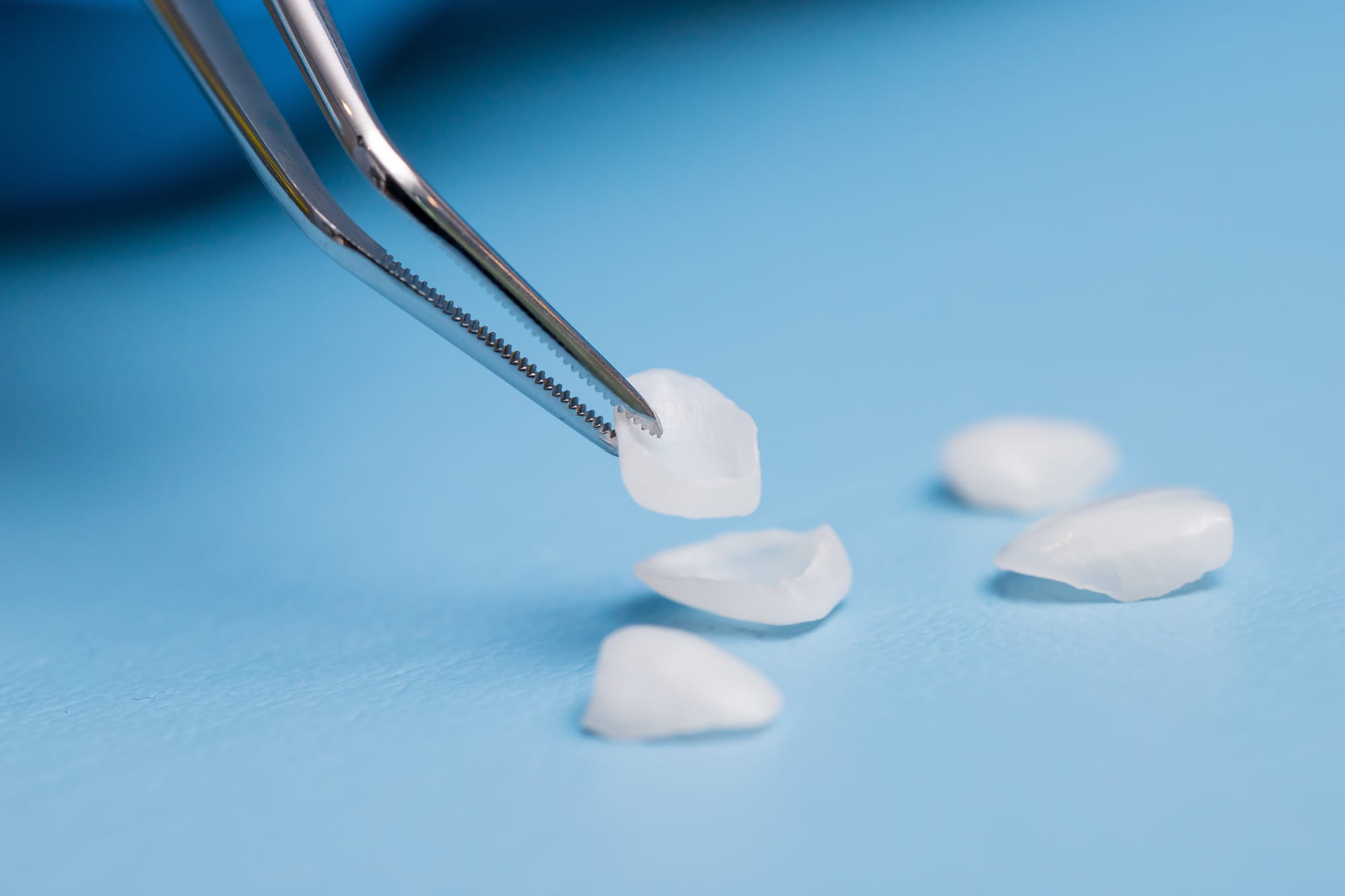Ultra-Thin Porcelain Veneers – Precision in Every Detail