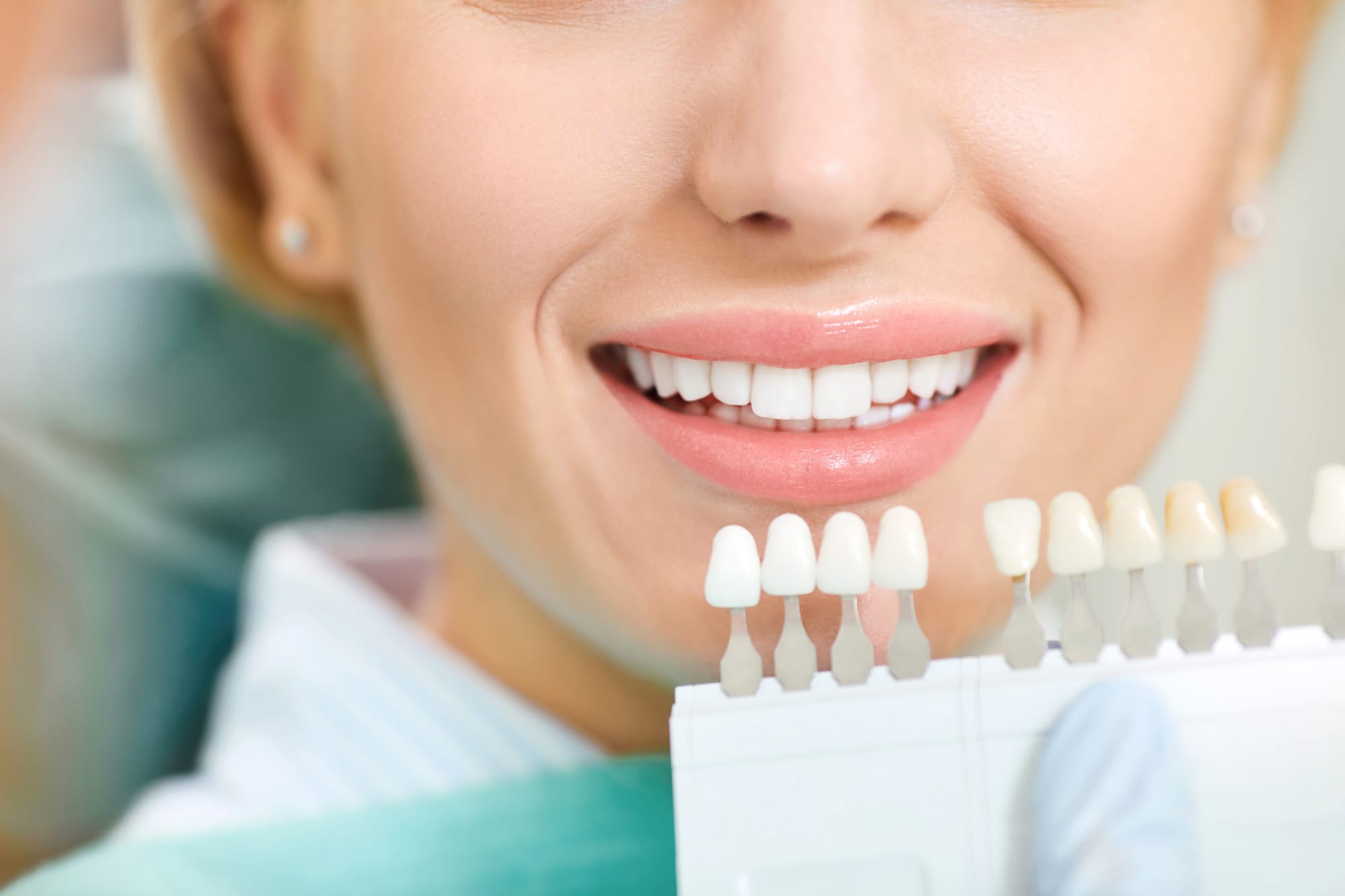 Shade Selection for Veneers and Hollywood Smile in Dubai