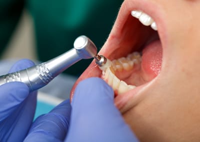 Optimizing Dental Health: How Often Should You Get a Professional Dental Cleaning?