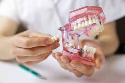 Tooth Replacement: A Comparative Analysis of Dental Implants and Bridges