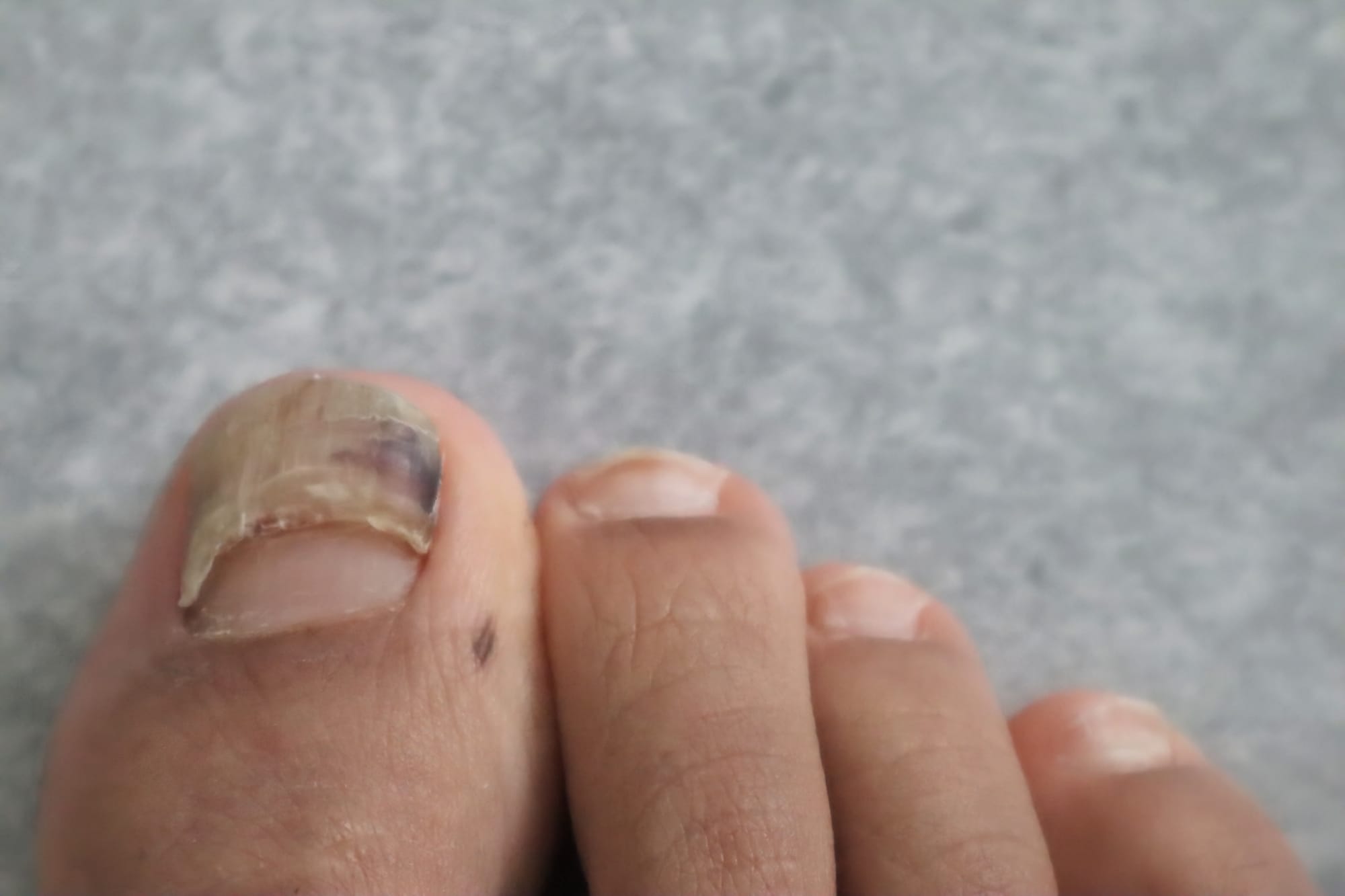 Nagelloslating
