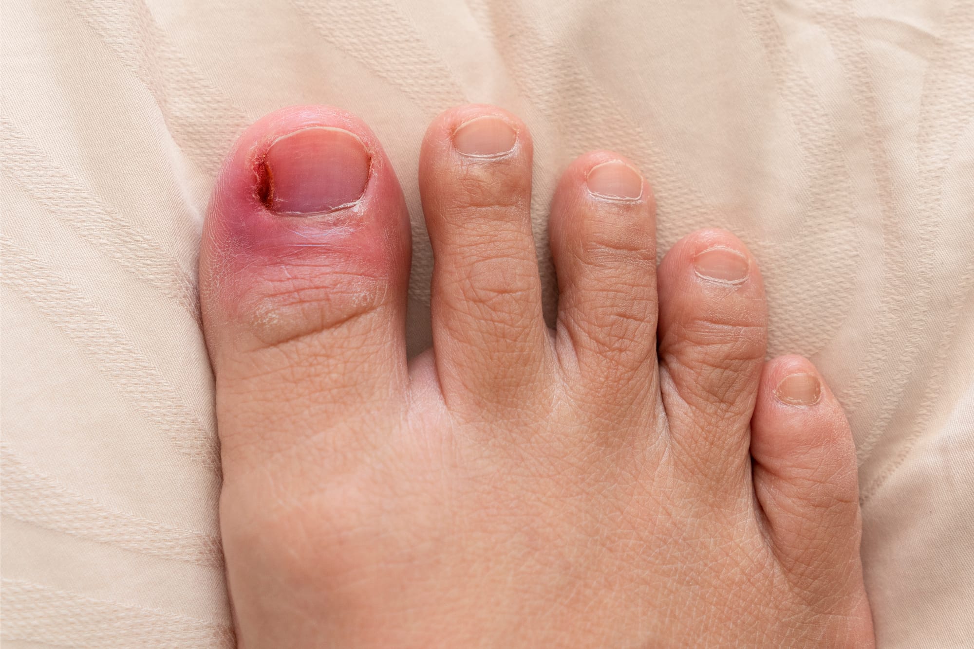 Nagelwal ontsteking