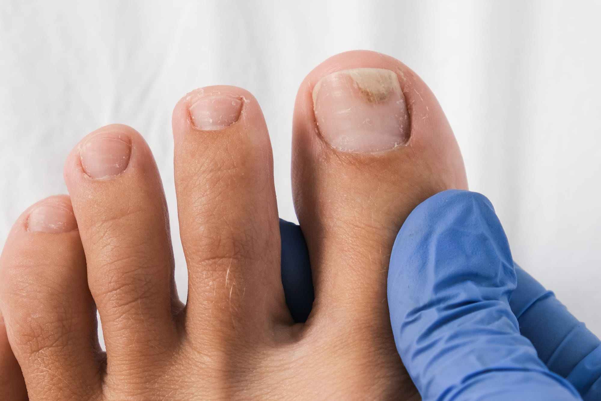 Onychomycosis