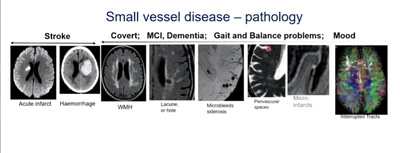 La Fundación Areces vincula demencia y salud cardiovascular